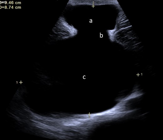 Ultrasound image demonstrating fluid collection within the umbilicus (a) tracking into abdominal cavity (c) originating from the cicatrix (b).