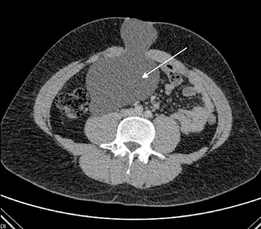 CT scan demonstrating bilobed cystic mass.