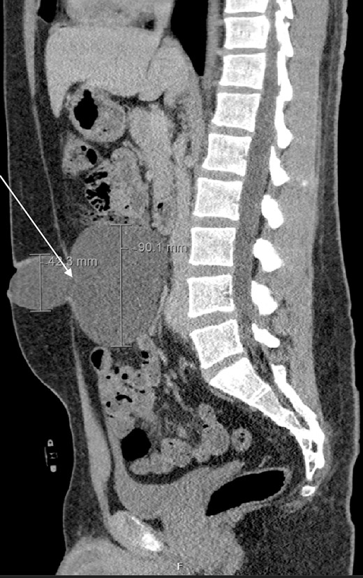 CT scan in sagittal cross-section demonstrating PIC.