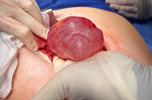 PIC was excised through midline laparotomy given the suggestion of retroperitoneal involvement on pre-operative imaging.