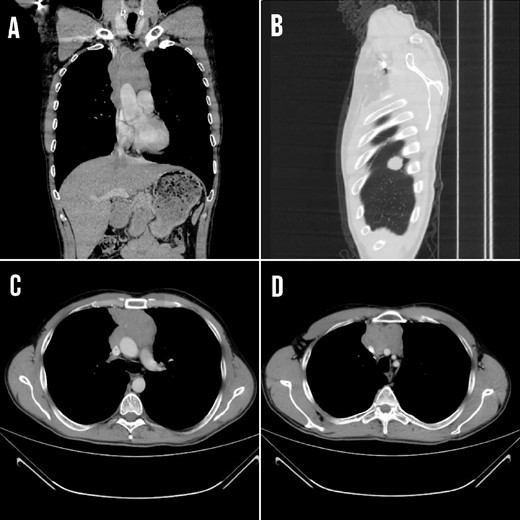 (A) CT coronal section showing the mediastinal lesion. (B) Right diaphragm metastasis at the posterior costal margin at the level of 4 and 5 thoracic ribs (C and D) Transverse section demonstrating the mass that compressed and invaded the major neck veins and the SVC.