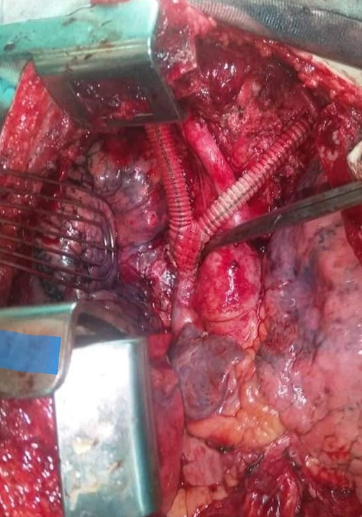 The inverted bifurcated 8/16 mm Dacron bypass between both right and left brachiocephalic veins and the superior vena cava.