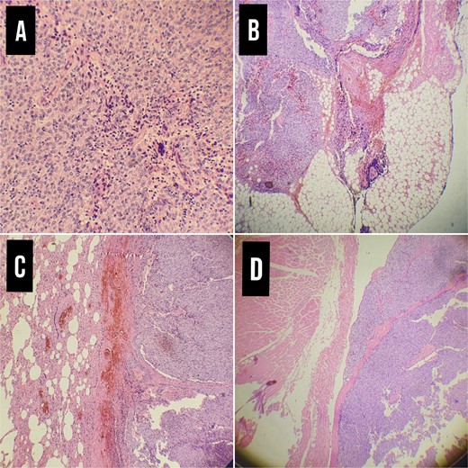 Pathological examination. (A) Thymoma WHO type 3B × 20, (B) Infiltration of the tumor in the adipose tissue of the pleura ×4. (C) Infiltration of the tumor in lung tissue× 4. (D) Infiltration of the tumor in the chest wall muscles.