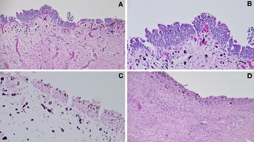 (A–B) Histopathological examination of the bladder biopsy demonstrated black pigmentation within the bladder mucosa and lamina propria histiocytes (H&E stain; A: 100×, B: 200×). (C) A Fontana Masson stain of the bladder biopsy was positive for melanin (special stain, 200×). (D) Histopathological examination of the transurethral resection of the prostate demonstrated black pigmentation of the stroma (H&E stain, 100×).