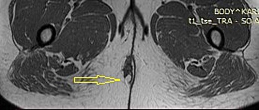 MRI with perianal endometriosis (arrow).