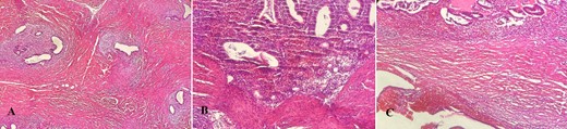 Histopathology report (hematoxylin–eosin stain). (A) Endometrial ectopic tissue. (B) Areas of hemorrhage in ectopic endometrial tissue. (C) Hemorrhage in endometrial tissue.