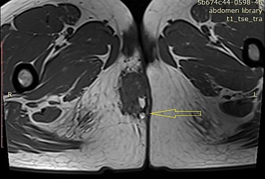 MRI image of a mass in the right perianal region (arrow).