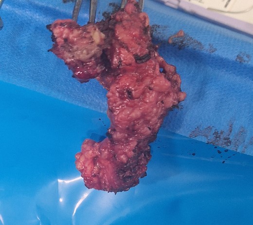 Excised endometrioma from the perianal region.