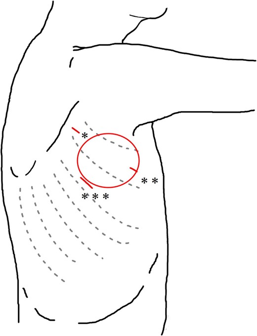 Schema of the surgical wound in VATS. *Third intercostal space on the anterior edge of the scapula. **Third intercostal space on the midaxillary line. ***Fifth intercostal space on the posterior axillary line. Circle: Location of swelling.