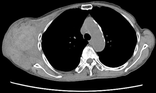 Chest CT at the time of the first bleeding showed formation of a hematoma on the right chest and front of the scapula.