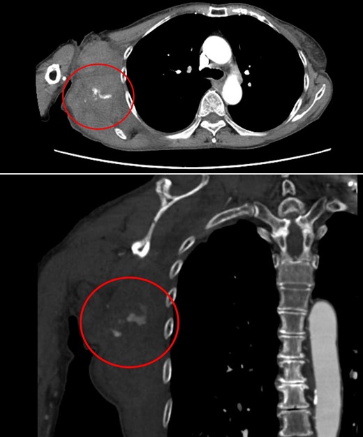 Contrast-enhanced CT at the time of the second bleeding showed growth of the hematoma and extravasation of contrast agent in a branch of the right lateral thoracic artery.