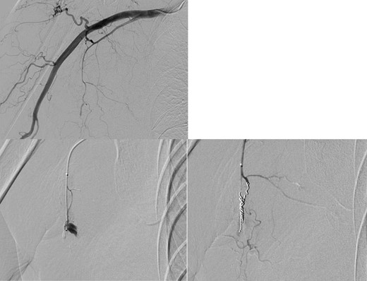 Angiography showed active bleeding from a pseudoaneurysm of the right lateral thoracic artery. Coil embolization was performed.