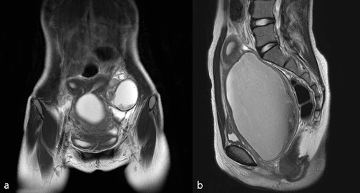(a) T2 coronal view, (b) T2 sagittal view of pelvic cavity MRI of Case 1; MRI revealed hematocolpos, hematometra, and ipsilateral ovarian endometriosis.