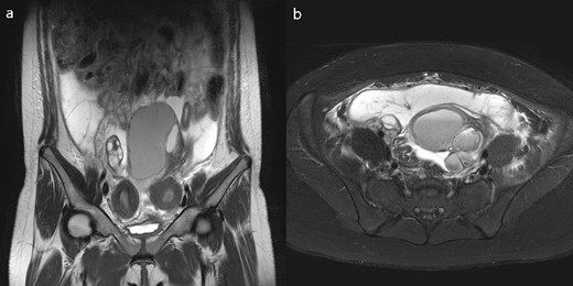 (a) T2 coronal view, (b)T2 axial view of pelvic cavity MRI of Case 2; MRI revealed a unicornuate uterus with a non-communicating rudimentary horn and unilateral ovarian endometriosis and hemoperitoneum.
