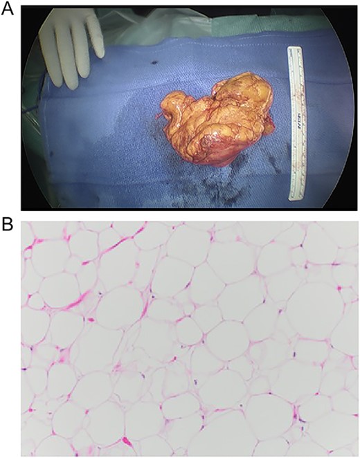 Macro- and microscopic findings. (A) Gross appearance of the lesion, (B) histological examination of the lesion, composed of abundant mature adipose cells with adipocytes exhibiting uniformity in both size and shape. 10× magnification, H&E stain.