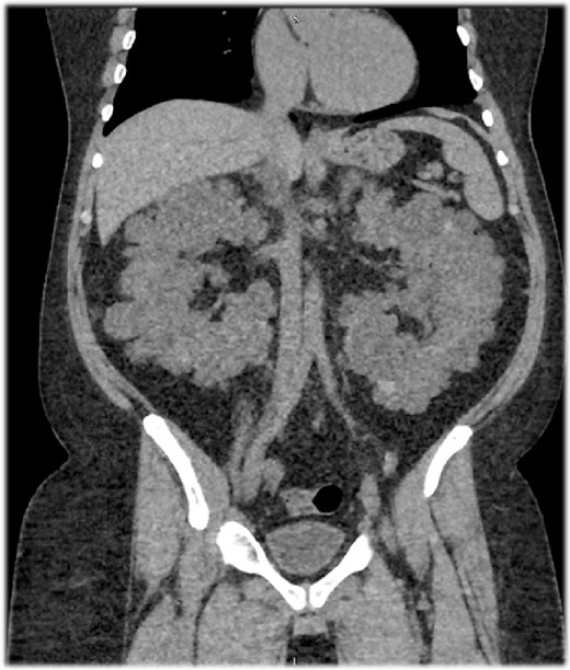 A sagittal section of a non-contrast computed tomography (CT) scan showing enlarged polycystic kidneys with the left and right kidneys measuring 16.5 × 10.1 × 11.3 cm3 with an estimated volume of 1.35 L and 16 × 9.4 × 13 cm3 with an estimated volume of 1.22 L, respectively. Both kidneys were filled with numerous cysts, replacing the normal renal parenchyma.