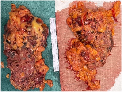 The gross appearance of the native kidneys after extraction. The Pathology report revealed presence of multiple cysts, most were empty, the rest were filled either with clear fluid or gelatinous material. No masses were identified.