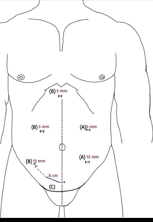 A diagram of the surgical incisions used during surgery. (A) 5-mm camera port and 12-mm working port position for left side nephrectomy; (B) 5-mm camera port, 12 mm working port and another 5-mm port used for liver retraction positions for right-sided nephrectomy; (C) the lateral end of Pfannenstiel incision extended to the right-sided 12-mm port incision on the day of kidney transplantation.