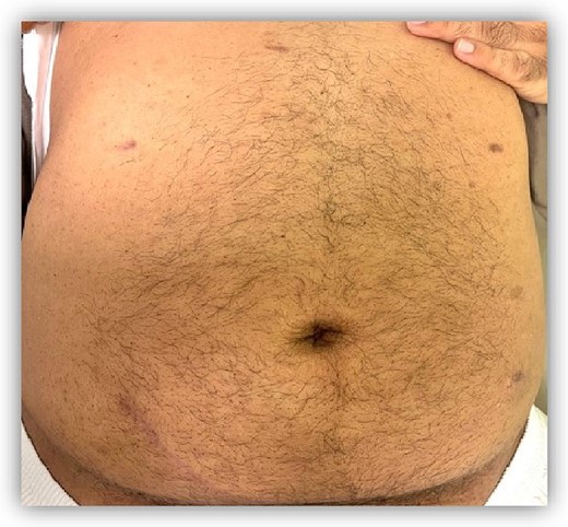 All skin incisions were closed in a subcuticular fashion yielding cosmetic scars 2 months post-operatively.
