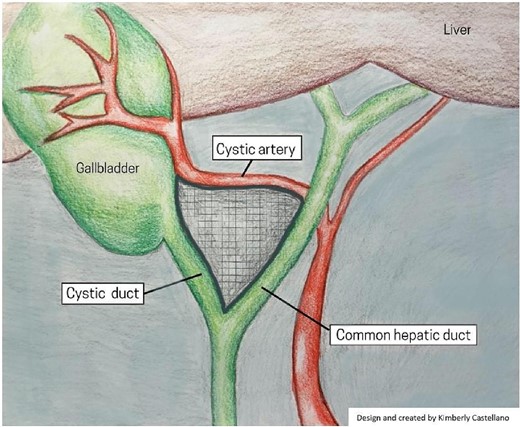 Illustrative depiction of Calot Triangle