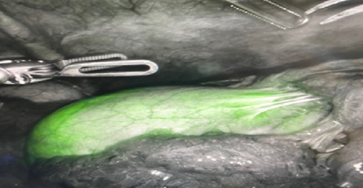 Initial illumination of gallbladder after ICG injection through PCDC.