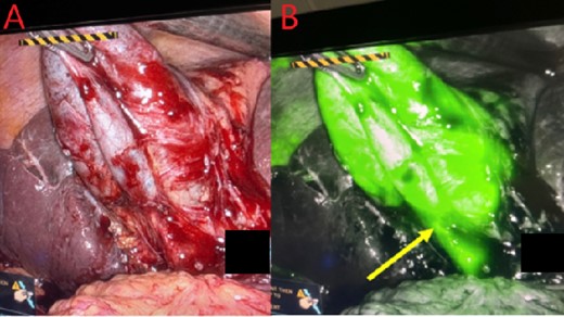 Gallbladder and cystic duct identification without (A) and with NIRF ICG (B). Arrow reflects improved cystic duct visualization.