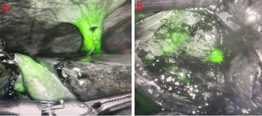 PCDC tract after administration of ICG. (A) is prior to surgical removal of gallbladder, (B) is postoperative liver bed.