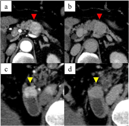 Computed tomography images: (a) arterial-phase axial computed tomography shows a hypervascular tumor in the pancreatic body, (b) the pancreatic tumor was washed out in the venous phase, (c) arterial-phase axial computed tomography shows a hypervascular tumor in the descending duodenum, and (d) the duodenal tumor was washed out in the venous phase.