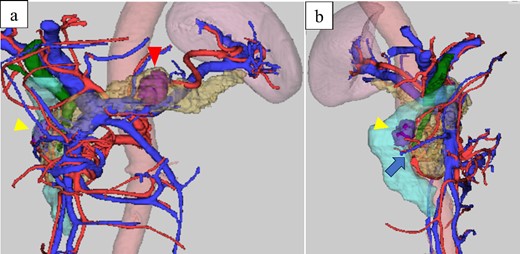 Computed-tomography reconstructed images: (a) frontal view and (b) right lateral view, the papilla of Vater; arrow, duodenal tumor was located near the papilla of Vater.