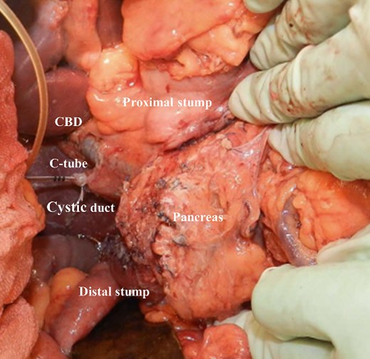 Intraoperative image after pancreas-sparing duodenectomy for duodenal tumor. The bulb and descending duodenum were resected.