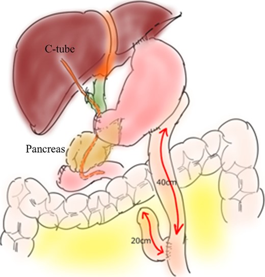 Depiction of reconstruction by the Roux-en Y method.