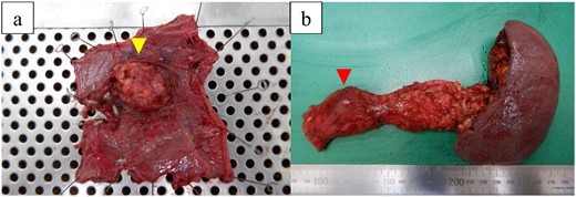 Macroscopic view of the resected specimens. (a) Specimen shows a 30-mm extramural tumor (arrow) in the duodenum. (b) Specimen shows a 30-mm tumor (arrow) in the pancreatic body.