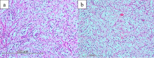 Histopathological findings (hematoxylin and eosin staining). Histopathological examination revealed pancreatic (a) and duodenal (b) metastases of clear cell renal carcinoma.