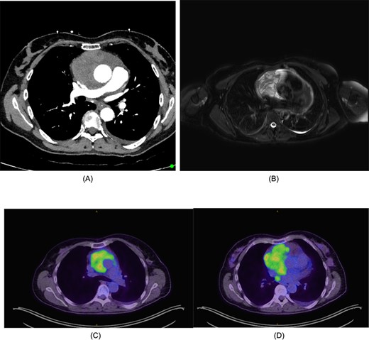 (A) CT chest/abdomen/pelvis demonstrating pericardial mass. (B) Cardiac MRI displaying cystic mass in the pericardium with small amount of pericardial fluid surrounding the lesion. (C) FDG-PET from the vertex to the upper thighs illustrating infiltrative lesion centred within the mediastinum. Small left pleural effusion noted. (D) Further focus of activity within the posterior mediastinum in the right para-oesophageal region.