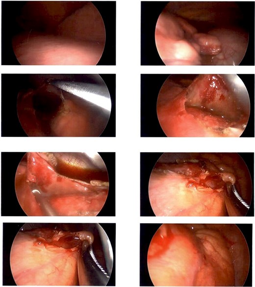 Intraoperative photography from left sided VATs biopsy. Showing a firm cream-coloured nodular and globular intra-pericardial mass containing gelatinous fluid was found circumferentially wrapping the ascending aorta.