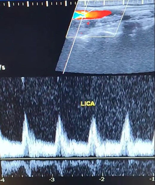 Duplex ultrasound showing a normal flow direction and insignifcant atherosclerotic plaques in the left internal carotid artery.