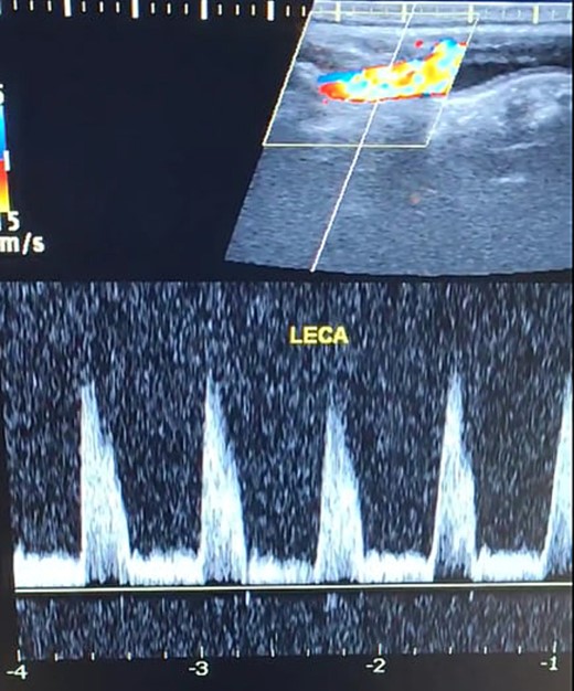 Duplex ultrasound showing a normal flow direction and insignifcant atherosclerotic plaques in the left external carotid artery.