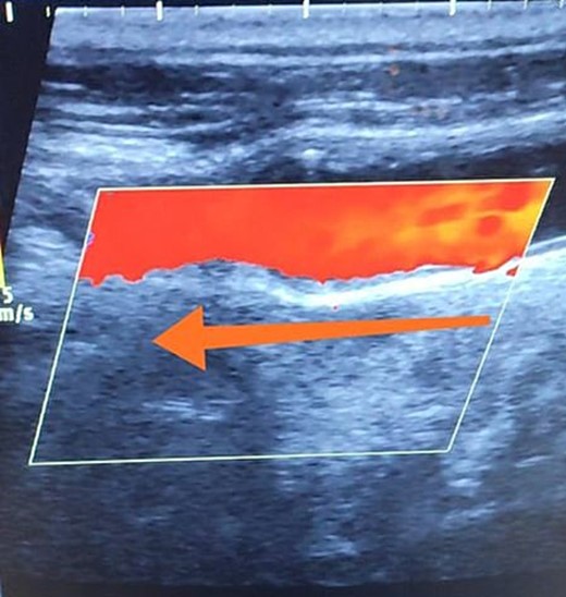 Duplex ultrasound showing a normal flow direction in the common carotid artery.