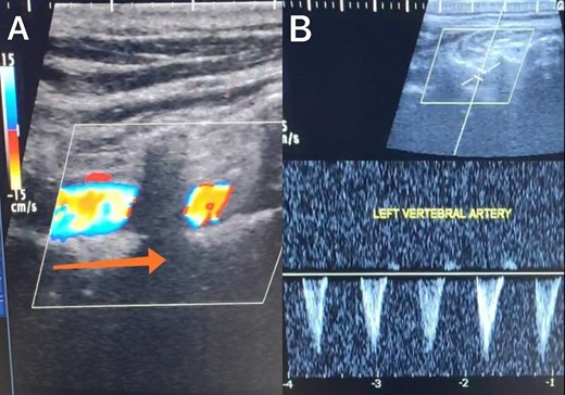 Duplex ultrasound showing a completely inverted flow direction in the left vertebral artery.