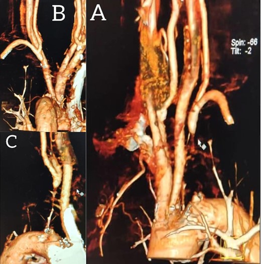 Multi-slice computed tomography angiography demonstrating 99% stenosis at the origin of the left subclavian artery.