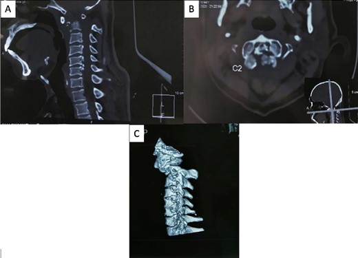 A cervical CT scan revealed an odontoid fracture and severe atlantoaxial dislocation. (A) Sagittal view, (B) axial view, and (C) lateral view of three-dimensional CT revealed atlantoaxial dislocation with odontoid fracture.