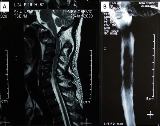 (A) Sagittal MRI showed significant compression on the occipitocervical junction due to atlantoaxial dislocation with blockage from (B) MR myelography.