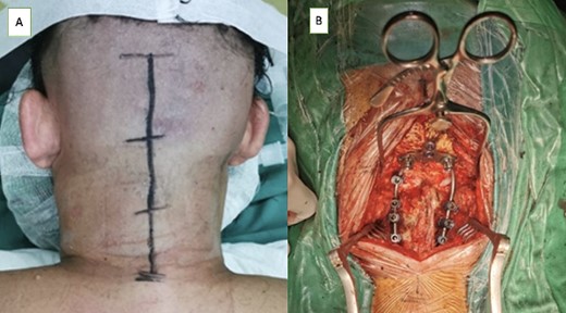(A) Midline skin incision was marked to expose from occipital bone to C3 level and (B) occiptocervical fixation using an occipital plate that fixated on occipital squama connected by a surgical rod through the C4 on both sides.