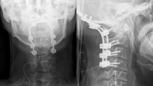 Postoperative x-ray showed proper occipitocervical stabilization.