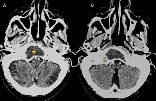 (A) Axial CT in soft-tissue window showing an intra clival fluid collection (star). (B) Axial Post contrast CT showing a peripheral enhancement (arrow).