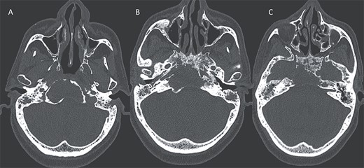 Axial CT in bony window showing: (A, B) extensive bone erosion of the clivus and the body and right greater wing of the sphenoid. (C) Soft tissue in the middle ear cavity and mastoid cells.
