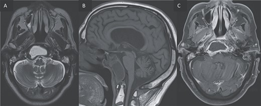 (A, B) Axial T2 and sagittal T1 images showing an expansile cystic lesion in the center of the clivus hyperintense in T2, hypointense in T1, with a rim hypointense in T2-weighted image. (C) Post-gadolinium T1-weighted shows a peripheral rim enhancement of the clival lesion.