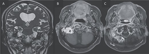 T2 coronal (A) and T1 post gadolinium axial images (B, C) showing the extension of the inflammation around the clivus and in the petrous, tympanic, and mastoid portions of the right temporal bone with small abscesses along the mastoid cells and the occipital bone.