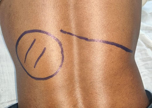 Clinical photograph showing a fullness in the left loin (cross marked within an oval). The line on the right side shows the location of the 12th rib on that side.