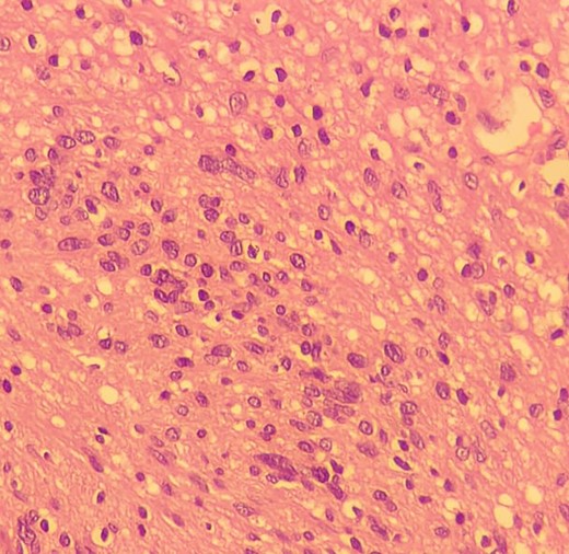 High-resolution 400x H&E histopathology image of the tumour showing nuclear atypia suggestive of ancient schwannoma.